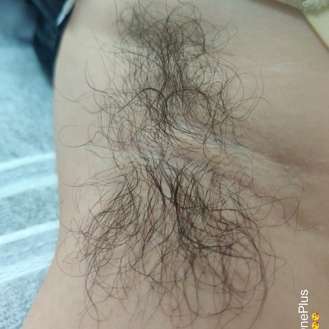 Before laser hair removal