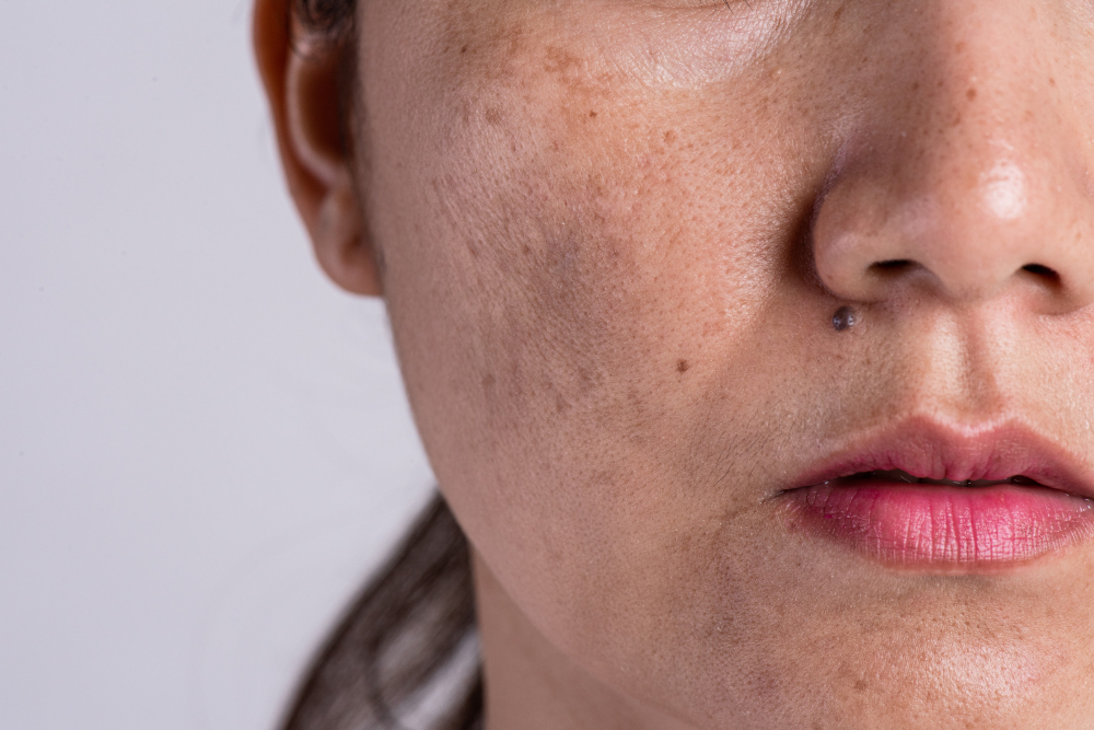 Pigmentation Correction