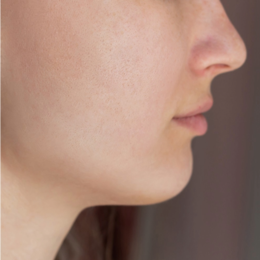 After acne treatment